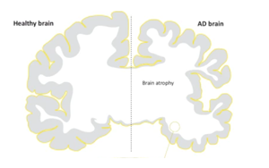 阿爾茨海默病中Tau蛋白病理對(duì)腦溝深度的特異性影響及其與海馬功能連接的關(guān)聯(lián)研究